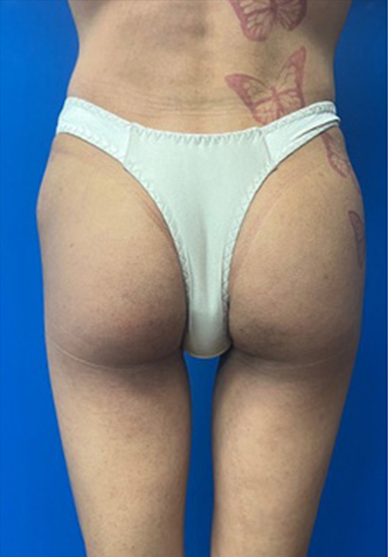Transgender Buttocks Enhancement